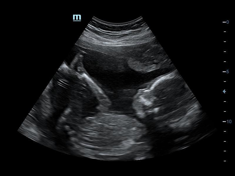 Private Early Pregnancy Scans for Reassurance From 6 Weeks - Hey Baby ...